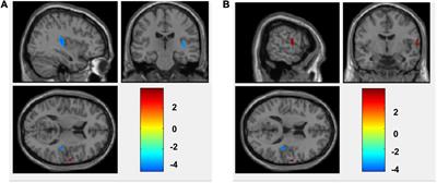 Cerebral Perfusion Patterns of Anxiety State in Patients With Pulmonary Nodules: A Study of Cerebral Blood Flow Based on Arterial Spin Labeling